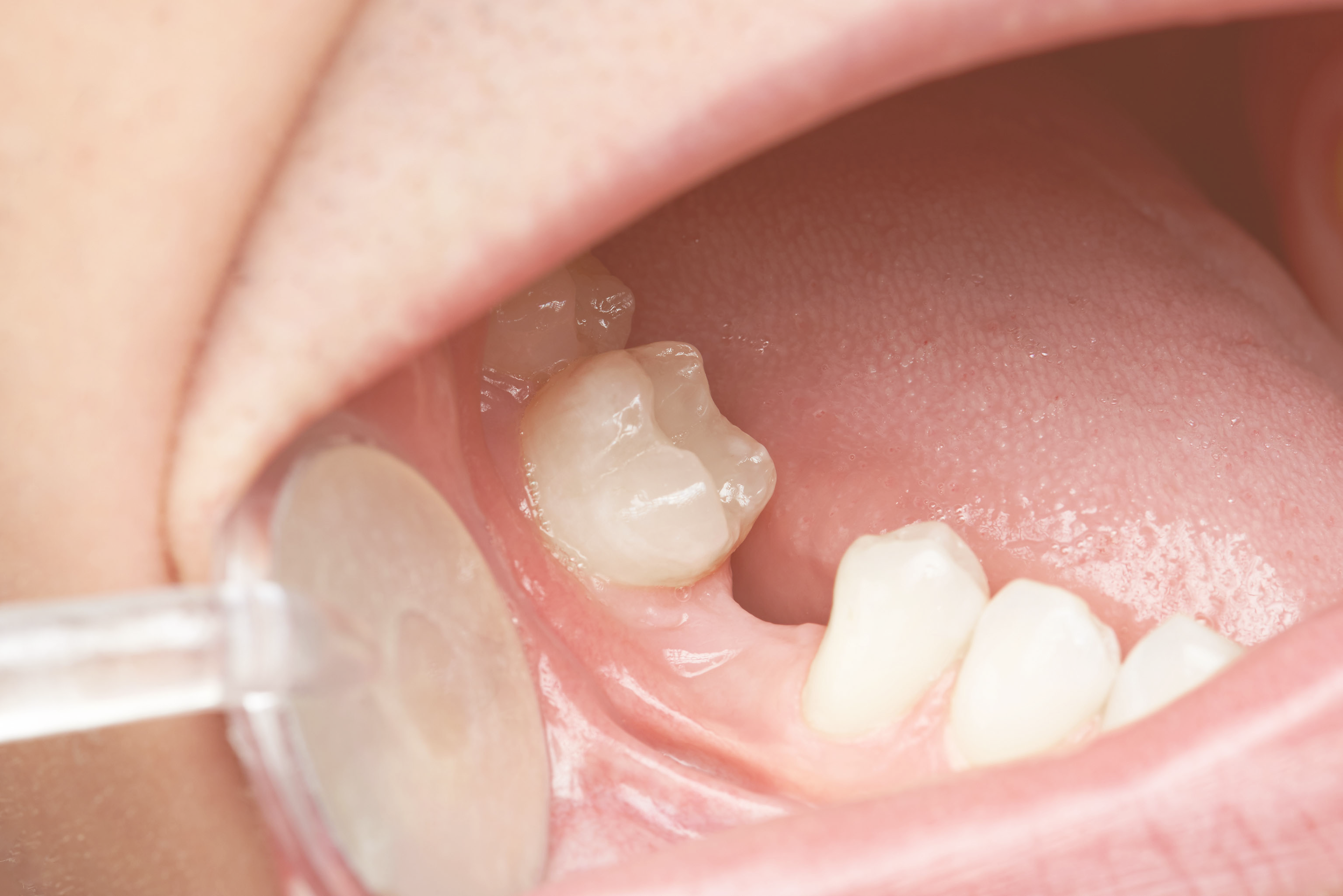 https://f.hubspotusercontent30.net/hubfs/4845087/GSD-BLOG-Bone-Grafting-Dental-Implants-Cosmetic-Dentist-BLOG-02.08.21.png