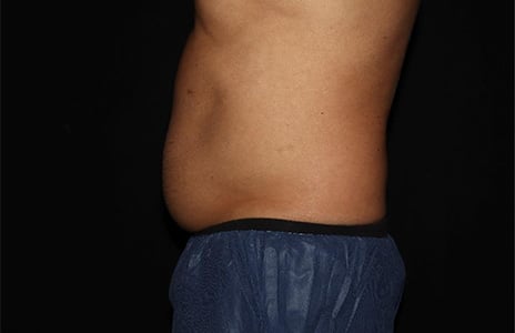 50% OFF Permanent Fat Loss  CoolSculpting, Body Sculpting & Weight Loss