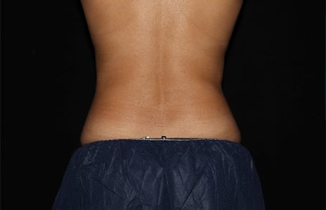 Coolsculpting in Orlando - Price Beat Guarantee