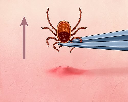 tick removal