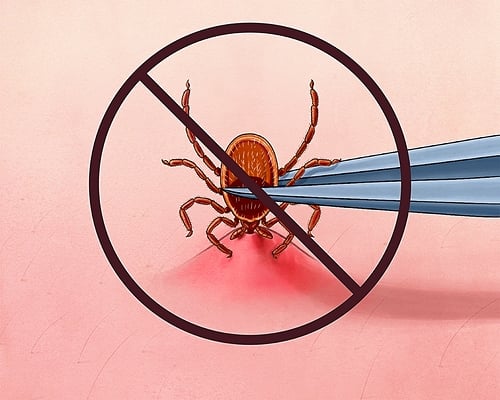 tick removal