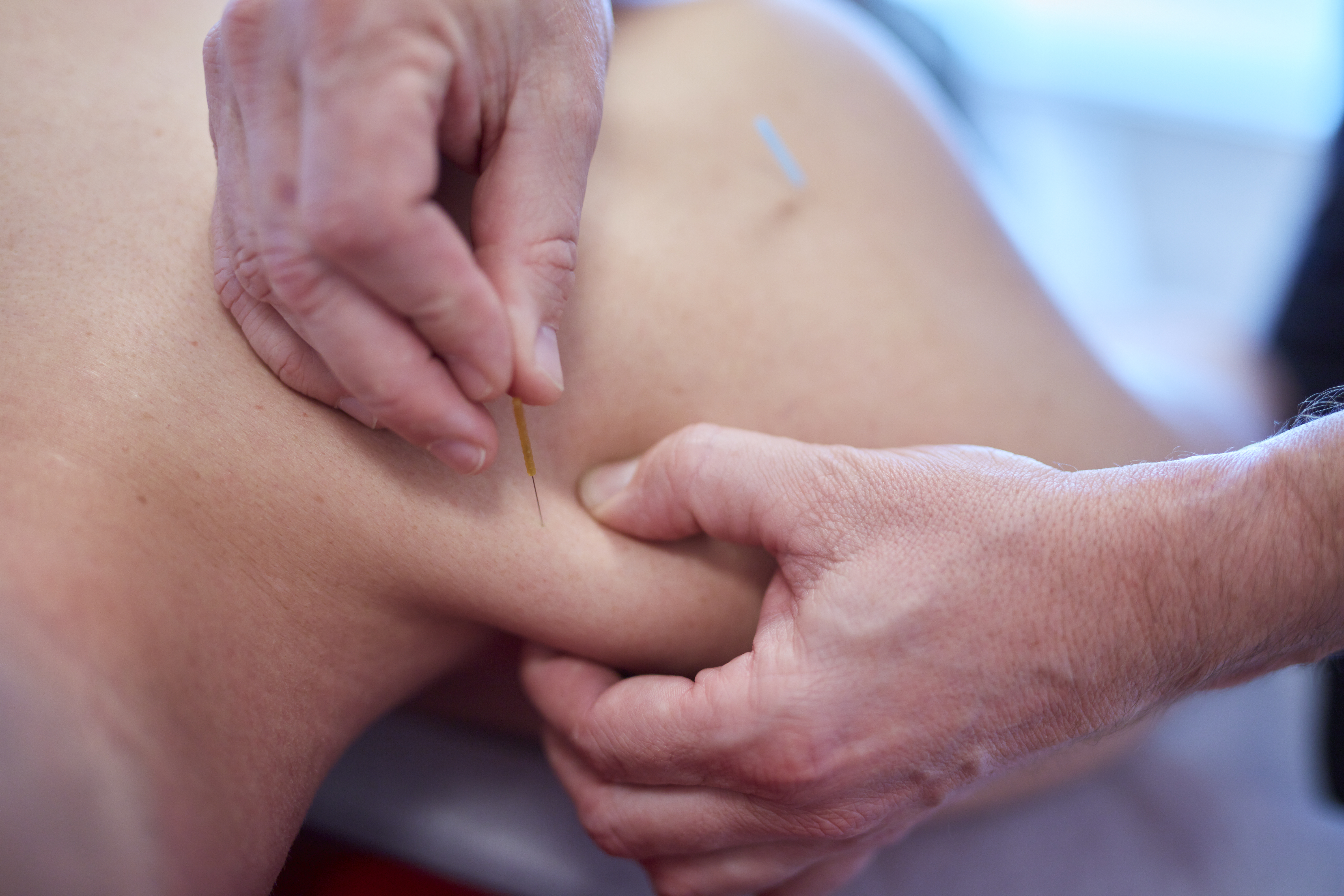 Akupunktur Randers i Fys og Sund Randers ved Fysioterapeut RAB