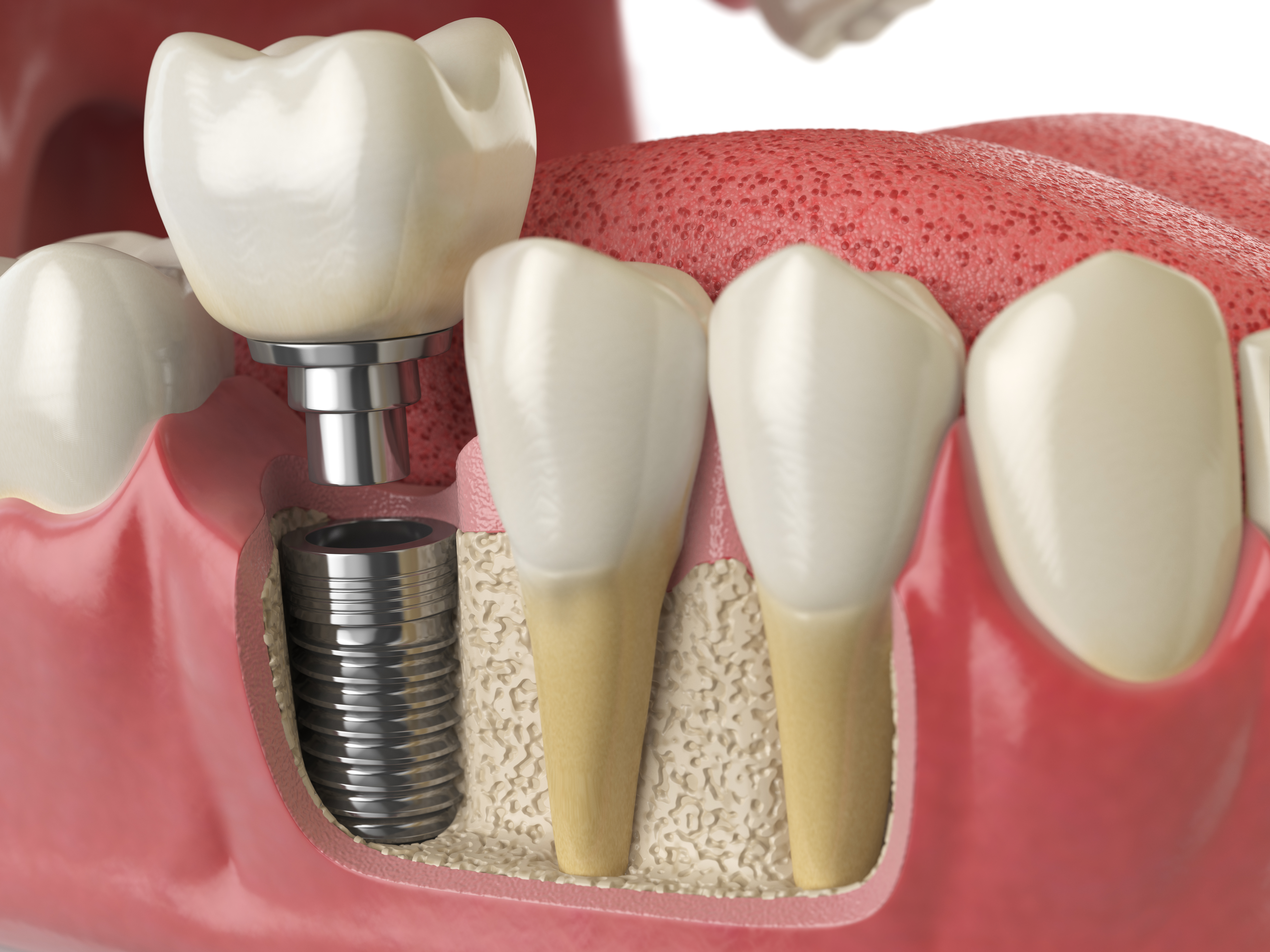 Через сколько можно вставлять зубы. Имплантаты Dentium Superline. Синус-лифтинг (костная пластика, остеопластика). Зубные имплантаты Straumann.