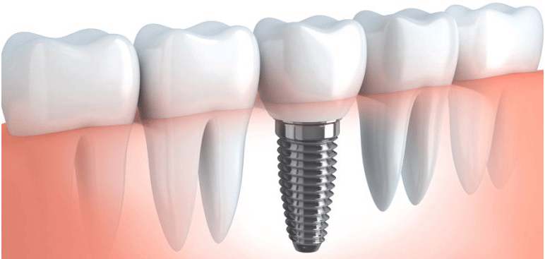 dental-implant-1