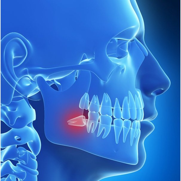 wisdom-tooth-extraction